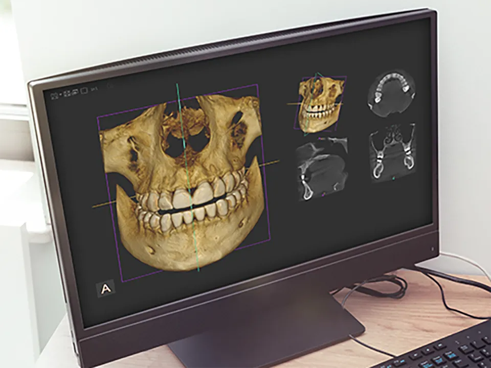 歯科用 3D CT